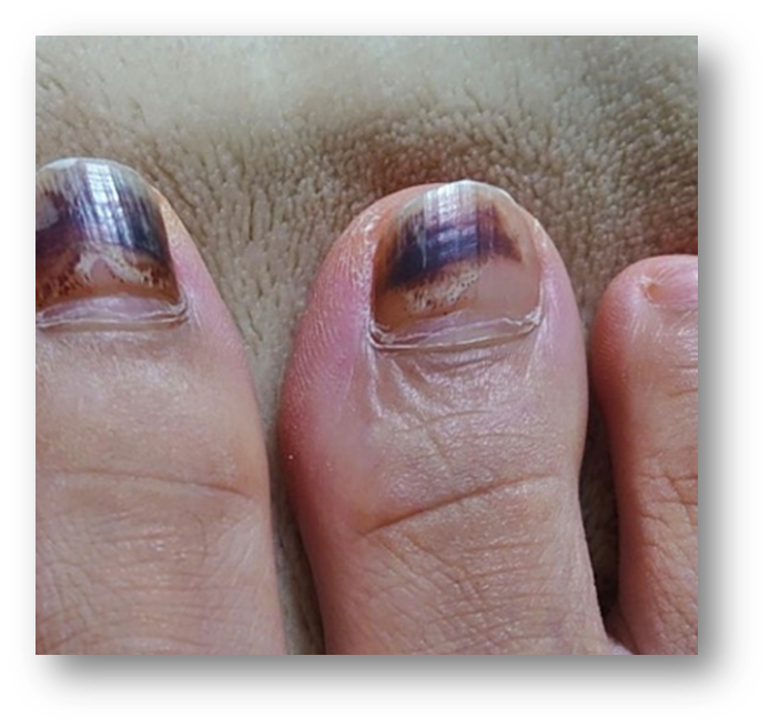 발톱 들렸을 때 1