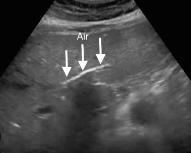 담도기종 (Pneumobilia)