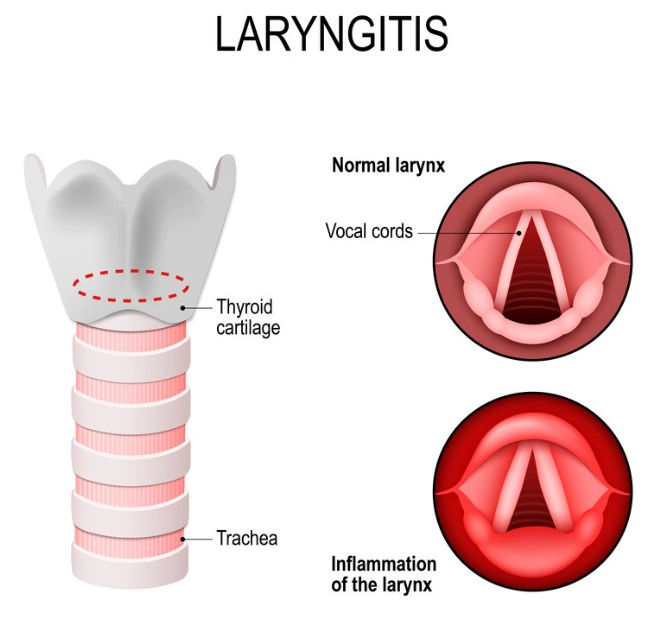 역류성 후두염 기침 증상 자연치료 방법 및 나쁜 음식 정리
