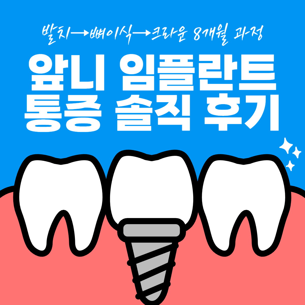 thumbnail-앞니임플란트후기,수술통증및과정