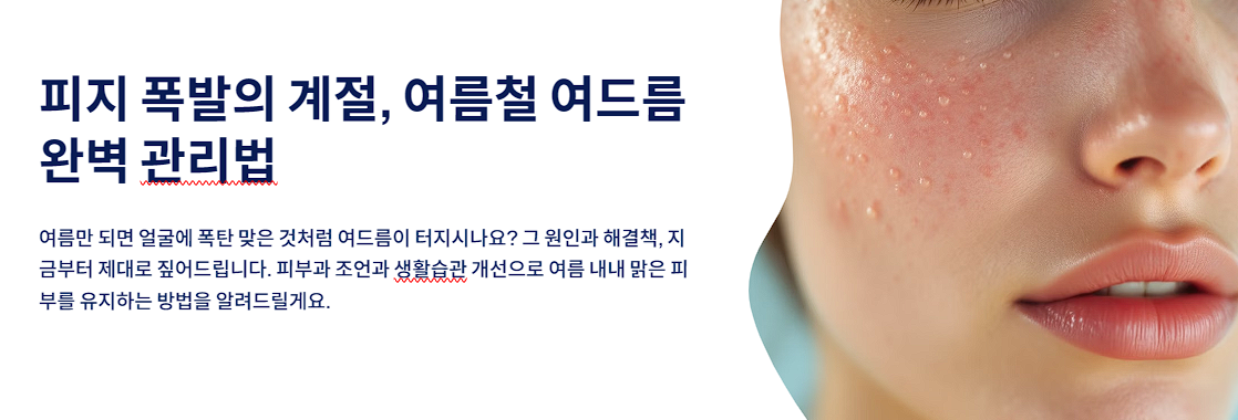 피지 폭발의 계절, 여름철 여드름 완벽 관리법