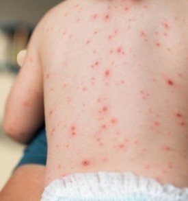 "수두"가 피부모습