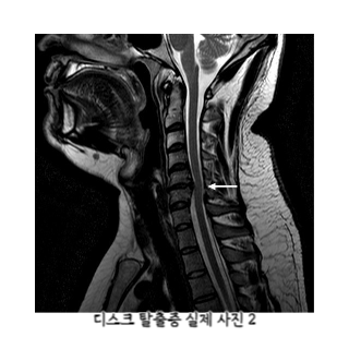 어깨통증원인