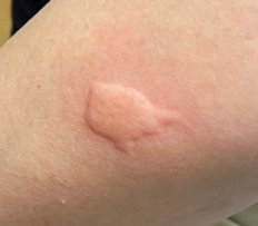 아기 모기 알러지증상(스키터증후군) 및 두드러기 챔프 알러논