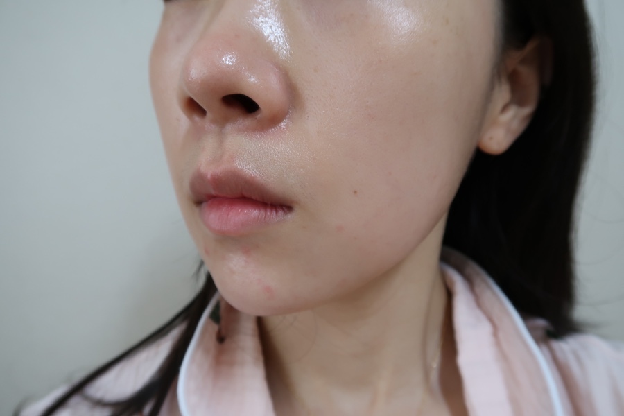 bbl 레이저 후기