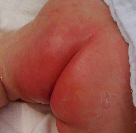 기저귀 발진의 원인은 무엇일까?