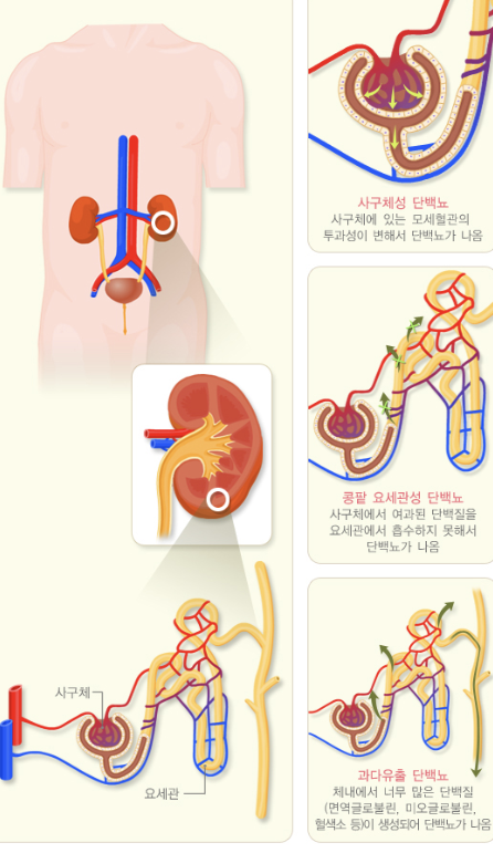 단백뇨의 원인 2