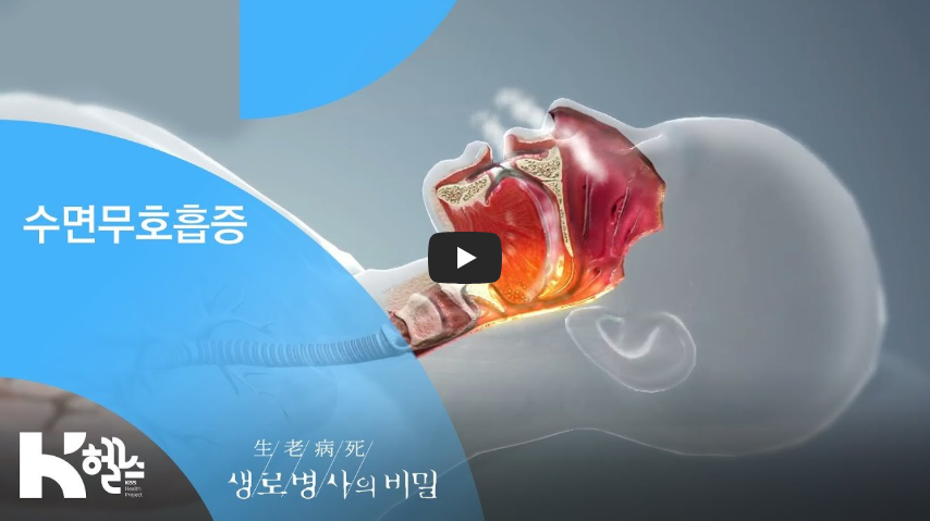 수면무호흡증 코골이치료 양압기 만성피로원인 수면다원검사