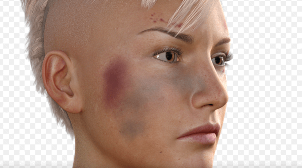 멍 빨리 빼는 법을 알아보고 있는 얼굴에 멍이 든 여성