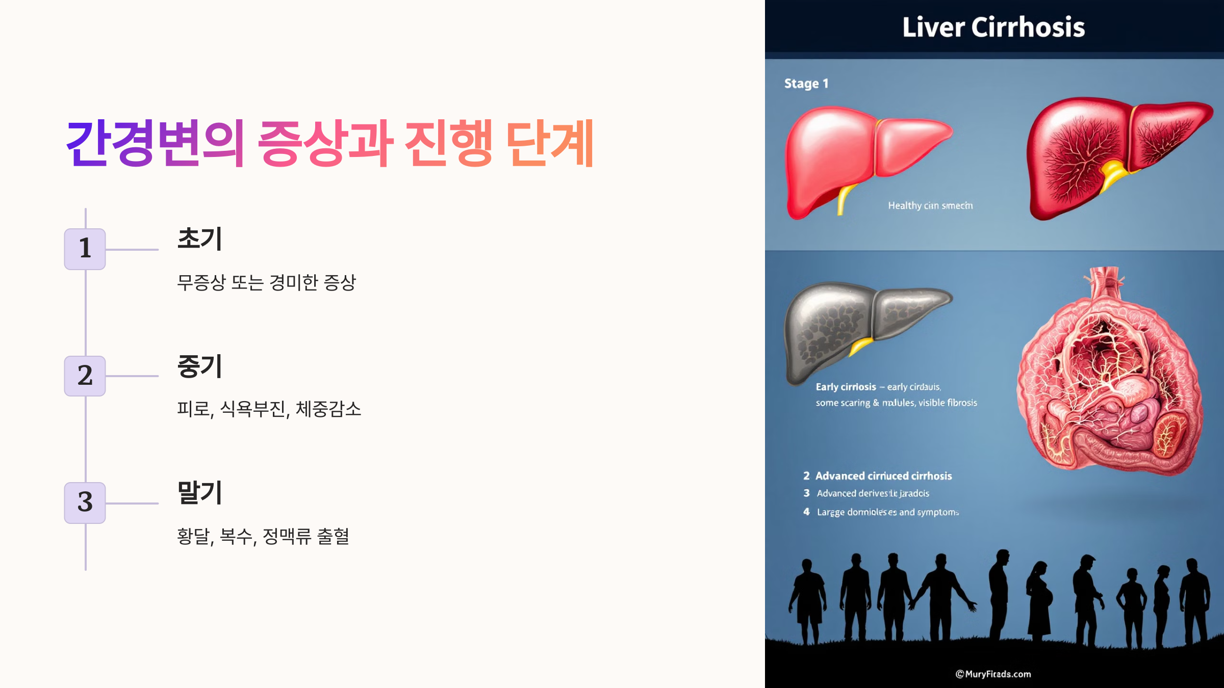 간경변의 증상과 진행 단계