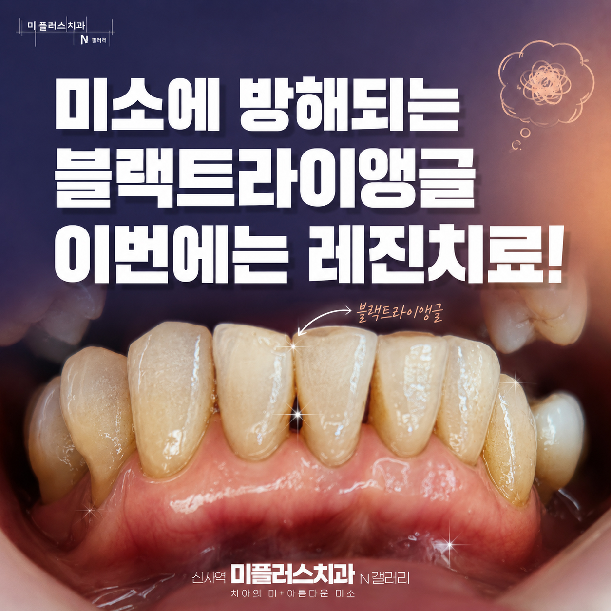 앞니 사이 검은 틈인 블랙트라이앵글 치료 전 구강 사진