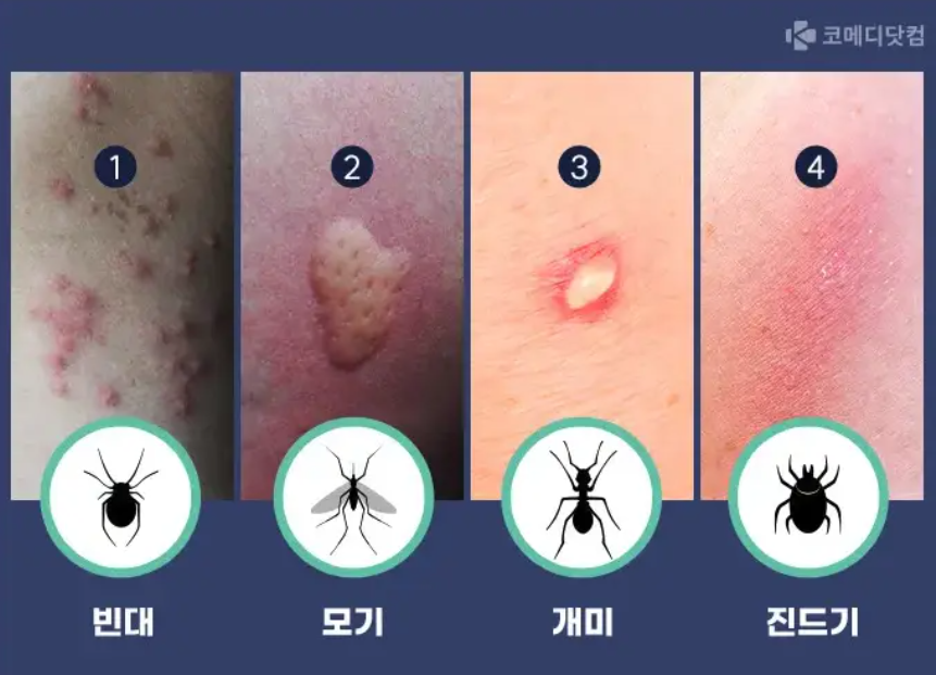 빈대 물린 자국