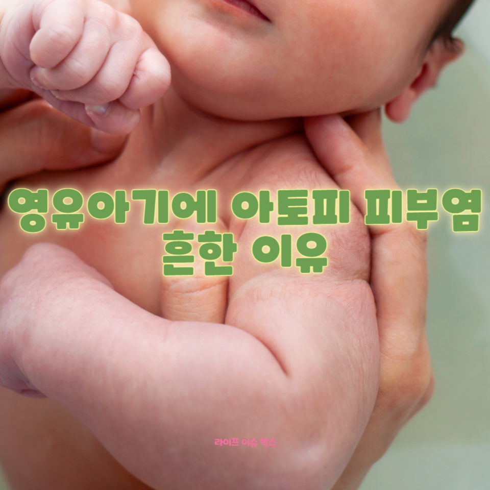 영유아 아토피 피부염은 부모에게 큰 걱정거리입니다.