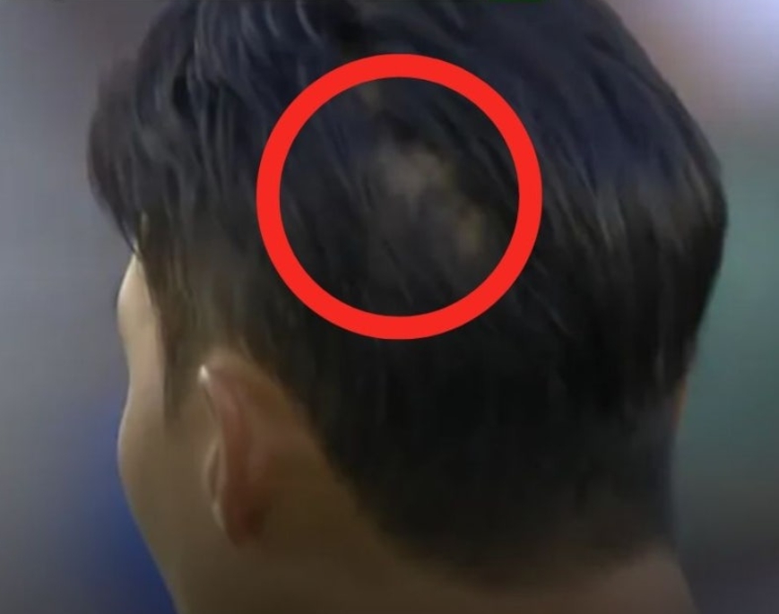 손흥민 원형탈모