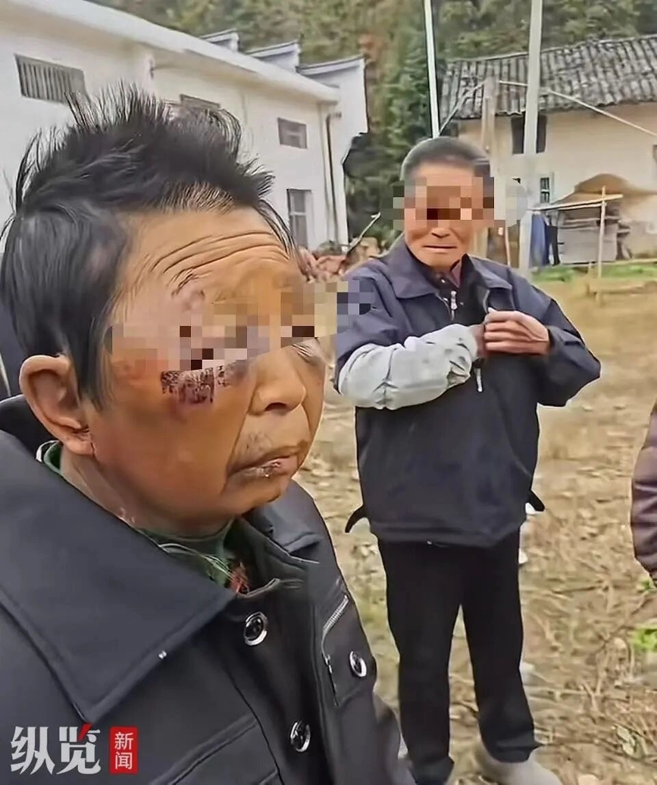 75세 남편의 두 차례 폭행”… 여성 얼굴 붓고 귀까지 변형, 전 국민 공분