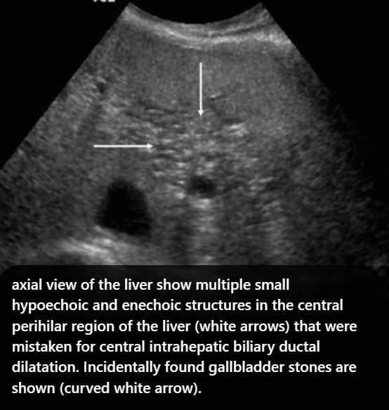 담관주변 낭종 (Peribiliary cyst)