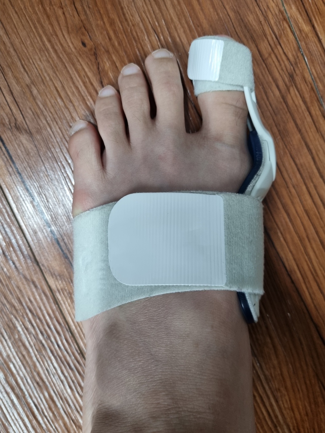 무지외반증-교정기-할루픽스
