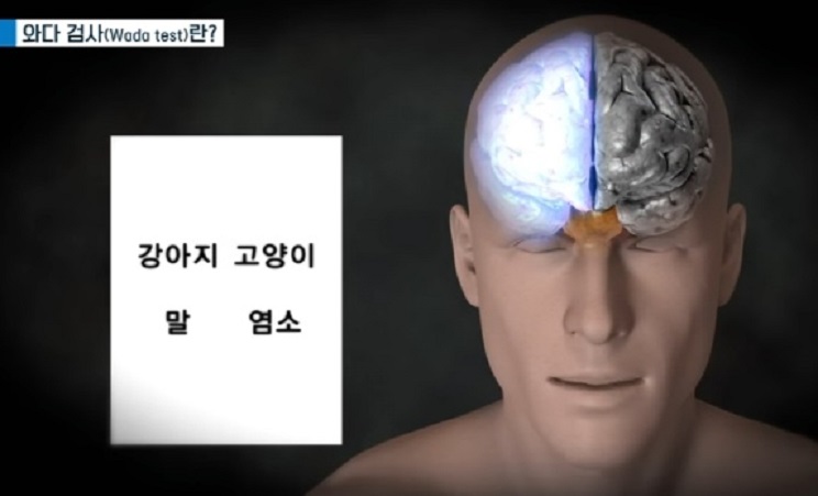 뇌전증-와다검사