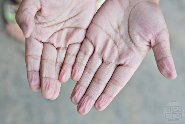 손가락 주름 병 질환 경피증