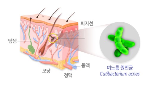 여드름