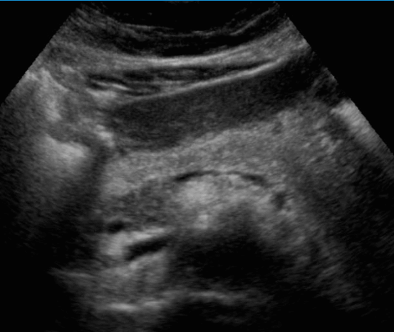 정상췌장의 초음파적 소견