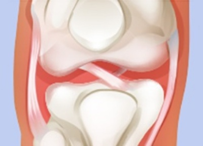 무릎관절염-1기