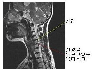 신경을 누르고 있는 경추에 모습이 보이는 엑스레이