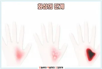 2도 화상 증상 자가치료 회복기간 응급처치법 정리_13
