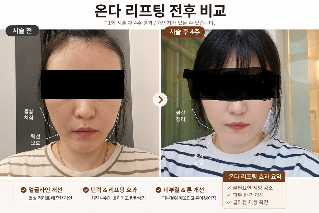 온다 리프팅 시술 전후 비교 이미지로 볼살 정리와 턱선 개선 효과를 보여주는 사진