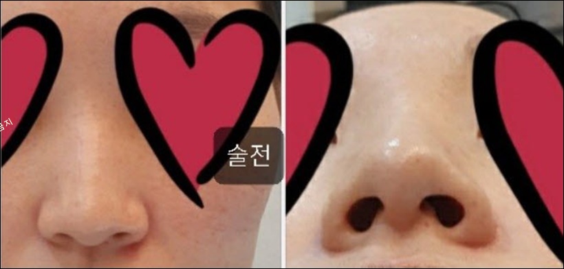 콧볼축소 수술 전