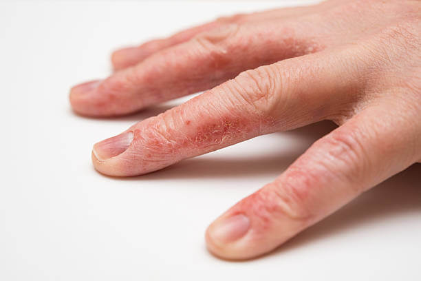비판텐 연고 효능&amp;#44; 종류 및 가격&amp;#44; 이 연고는 아기의 기저귀 발진이나 피부 트러블에 성인이 사용할 수 있고 기저귀로 인한 발진이나 놀다가 긁힌 상처 등 다양한 분야에 사용되는 연고입니다. 스테로이드가 없고 처방전 없이 사용 가능한 비판텐 연고 종류와 가격 그리고 효능을 읽어보시기 바랍니다.