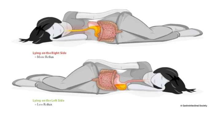 역류성 식도염 야간 증상&amp;#44; 밤에 누우면 더 아픈 이유