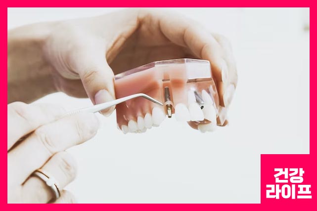 임플란트 뼈이식 4가지 유형