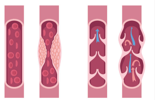 하지 정맥류 증상 수술비용