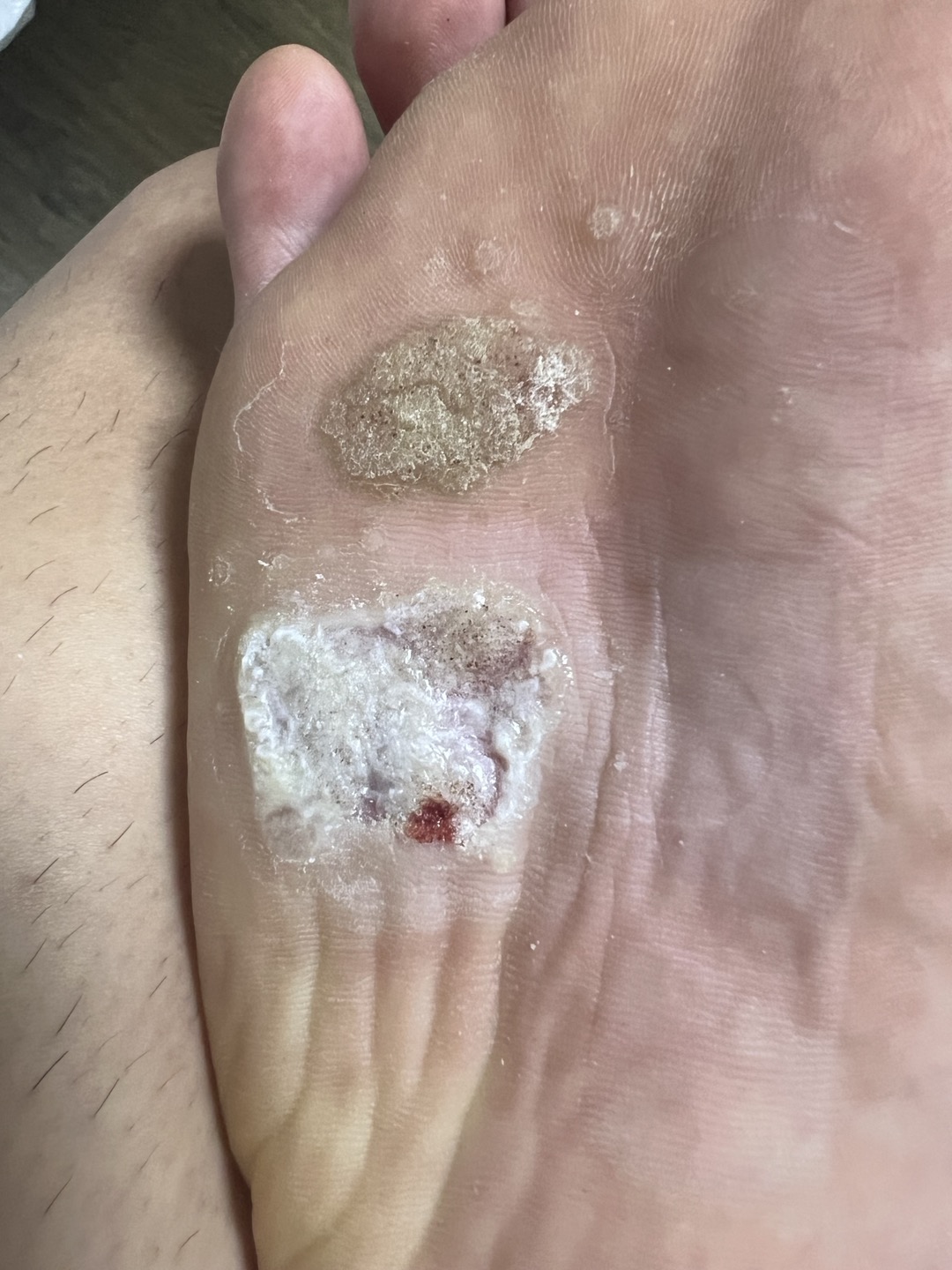 발바닥 사마귀 자가치료