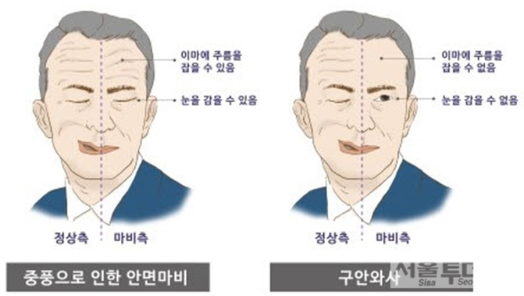 구안와사 초기증상 2
