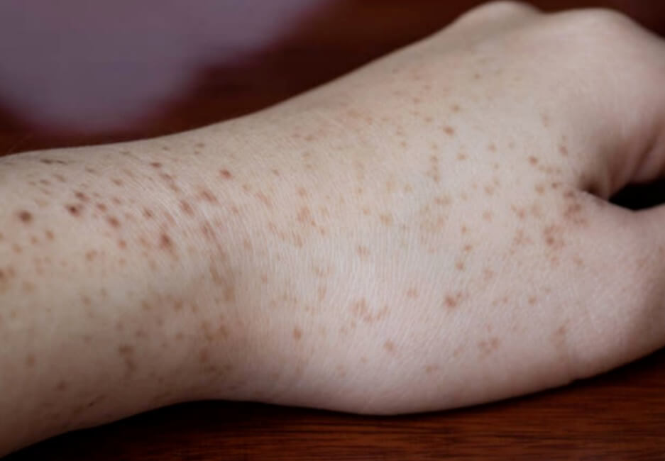 모공각화증 피부 증상