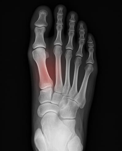 발등 통증 원인