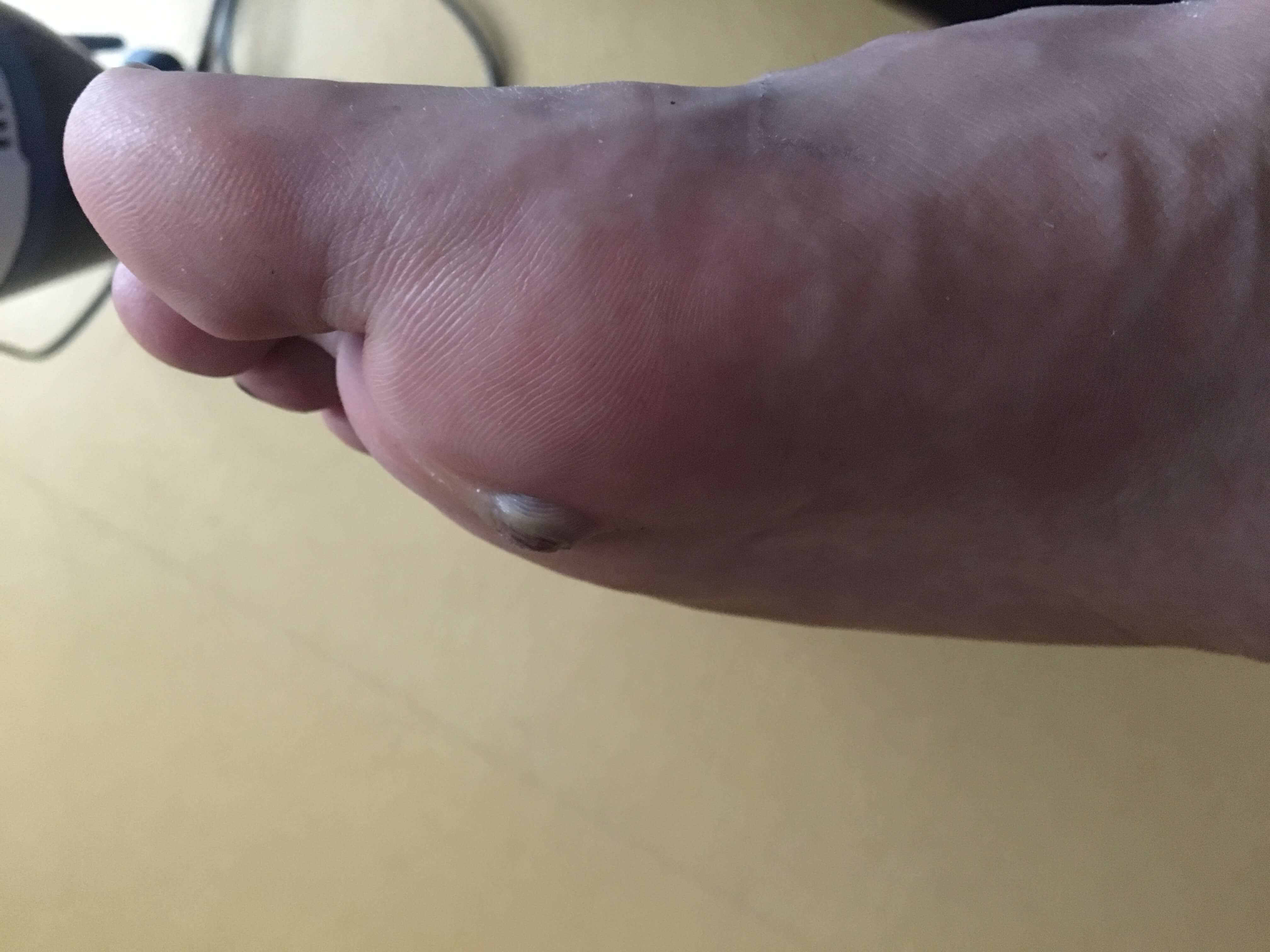 첫번째 냉동치료 당일 밤