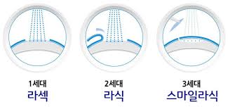 스마일 라식