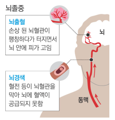 뇌졸중 뇌출혈 뇌경색 비교