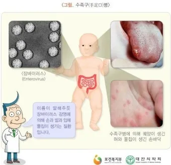 수족구병 증상과 예방 조치 방법 모음_10