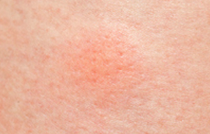 모기에 물린 자국