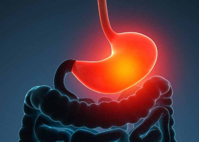 위염이-발생한-위의-모습