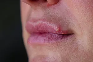 대상포진 예방접종 가격