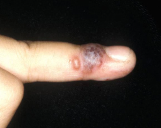 헤르페스 손발톱주위염