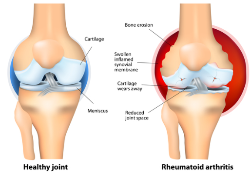 류마티스관절염