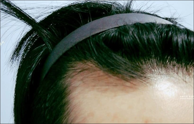 m자 탈모 초기
