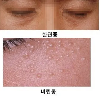 비립종 생기는 이유 비립종 없애는 방법 피부 관리법_2