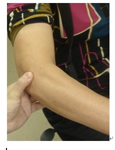 테니스 엘보 사진출처 대한정형외과학회 홈페이지